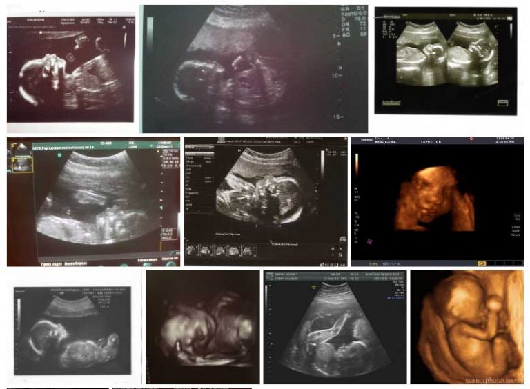 Semana 22 de Embarazo (Síntomas, Ecografía, El Bebé y La Panza) Semana 22 de Embarazo (Síntomas, Ecografía, El Bebé y La Panza)